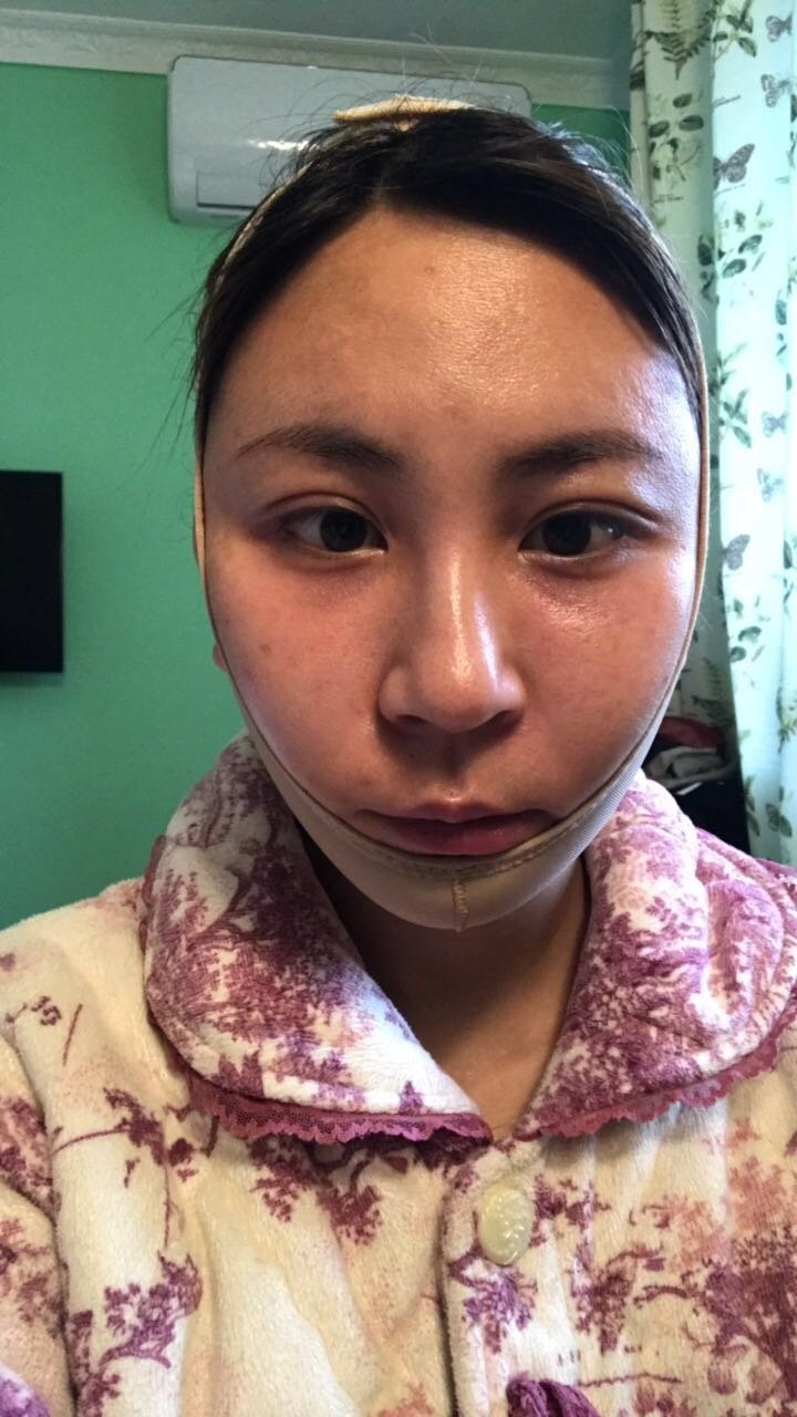 面部吸脂怎么样_恢复过程_效果如何_胡南婷整形日记11
