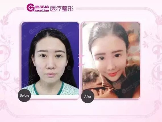 主要是先天发育不对称,后天的半侧颜面萎缩;现在比较多的是做双