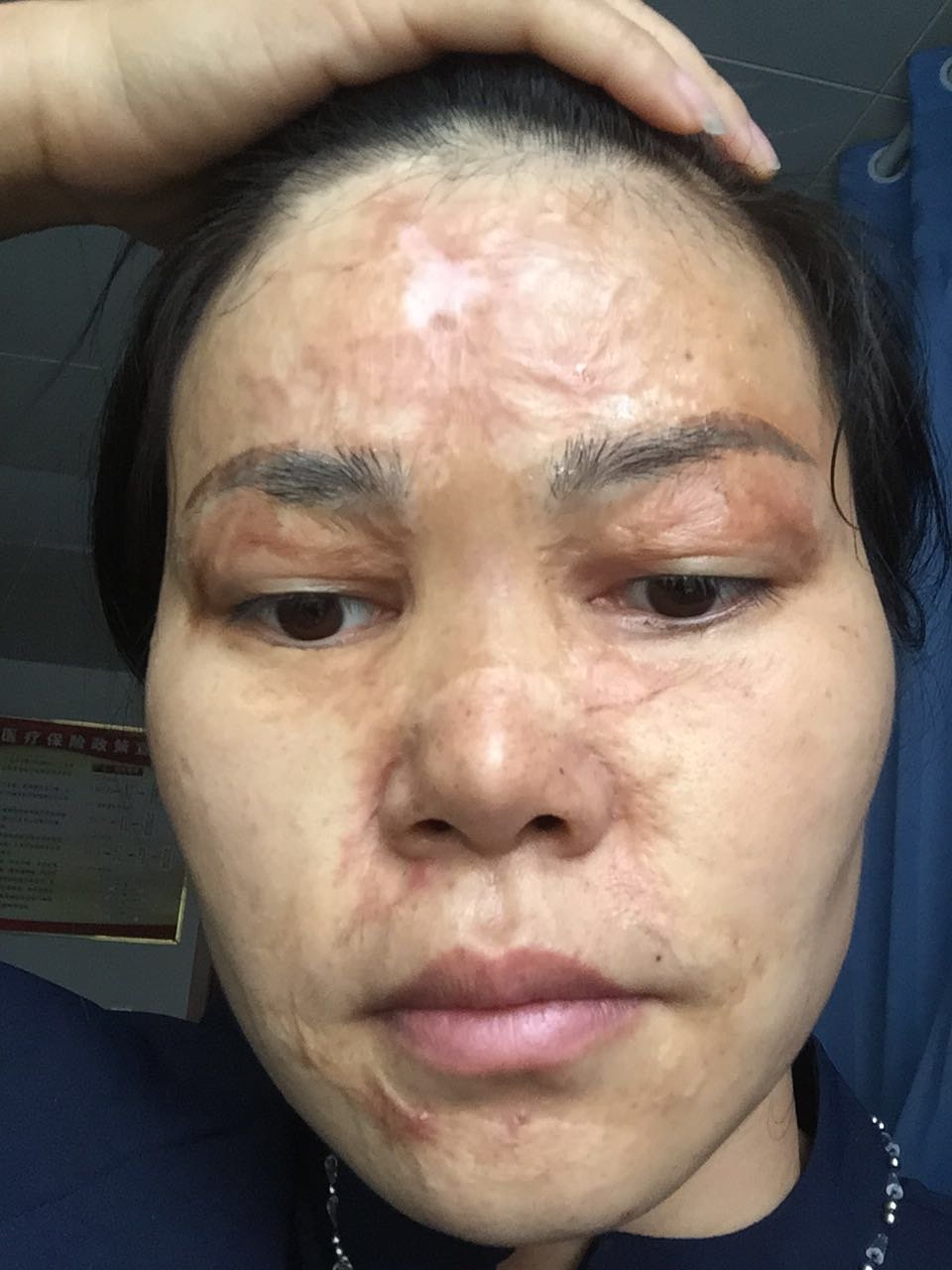 深圳广和门诊部激光祛疤怎么样?_宁宁23美丽日记-新氧