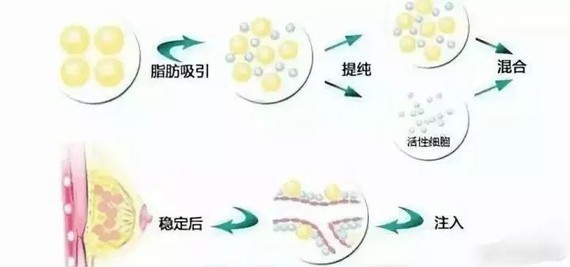 90%女性都不知道的自体脂肪隆胸和假体隆胸