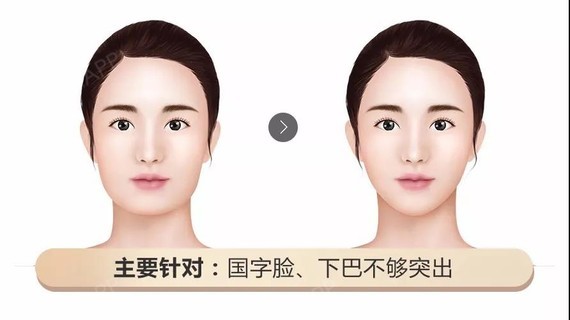 瘦脸针 玻尿酸丰下巴 脸部线条模糊,除了咬肌肥大外 还存在下巴短小或