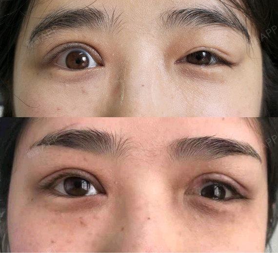 左眼睑裂小,睑缘最高点位于瞳孔上缘,呈角状畸形.