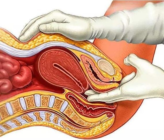后方膣圆盖术是首先把下垂的子宫恢复原位之后,从宫颈