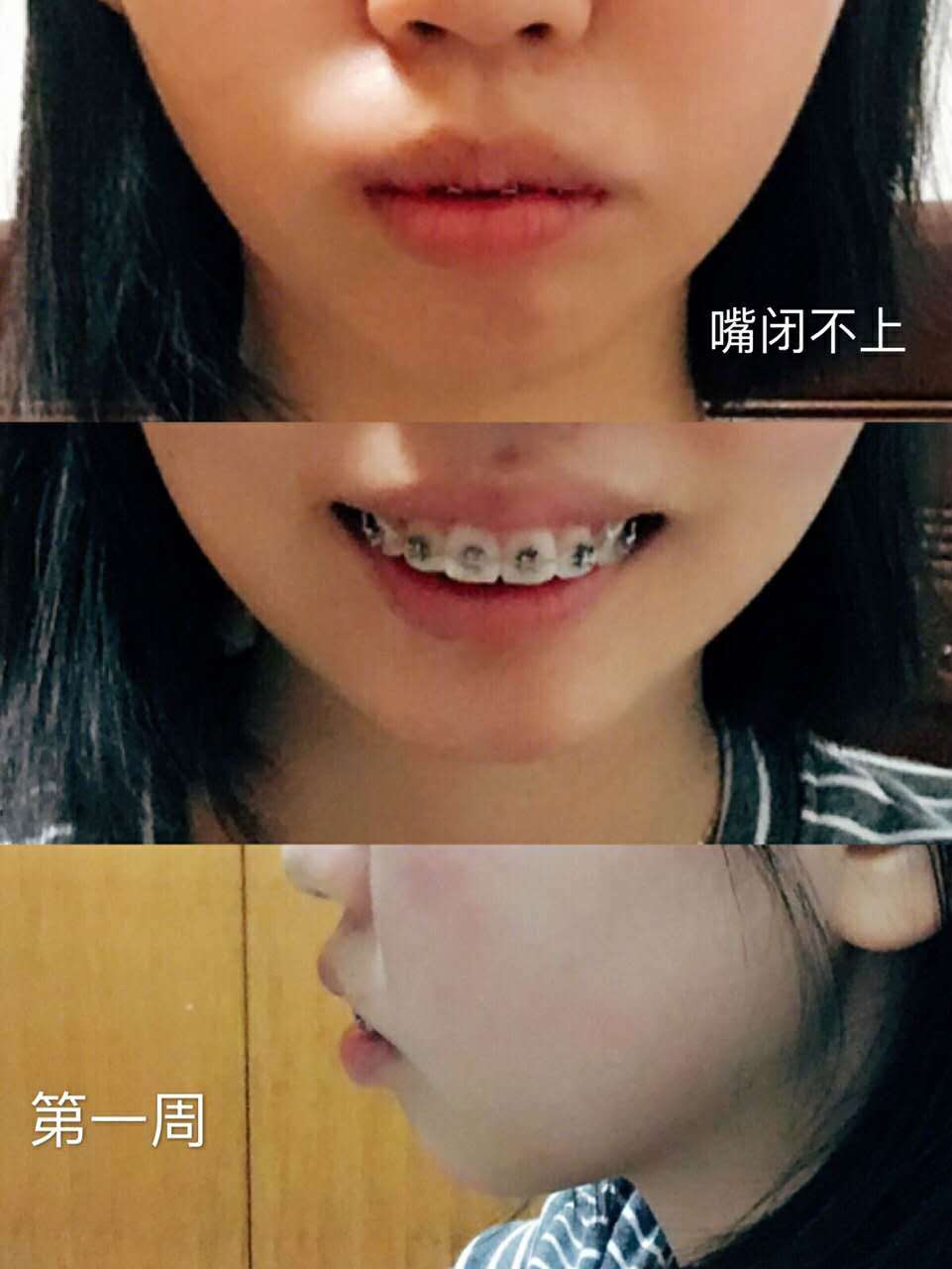 牙齿矫正两年,骨性深覆合,阶段详细对比图.