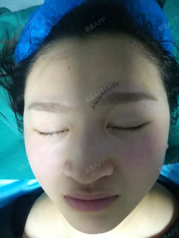 【凹陷疤痕】我这个疤痕在左边眉毛上,挺明显的,是去年不小心摔伤留下