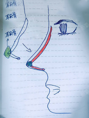 这是单纯隆鼻改良后的术式 不知手绘的示意图看懂了吗?