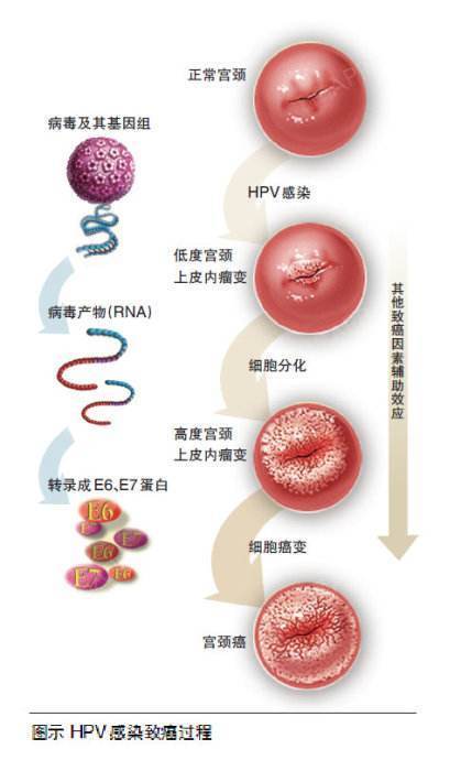 宫颈癌hpv筛查与hpv疫苗