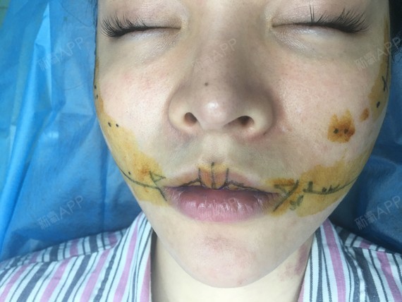 之前刘咨询说我的适合手术的,本来梨涡就是若隐若现的 要是做埋线话