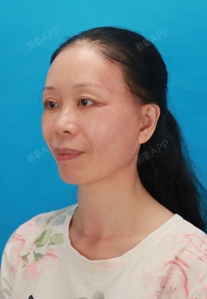 拉皮手术的疤痕也淡了很多,不凑近看,基本看不见.