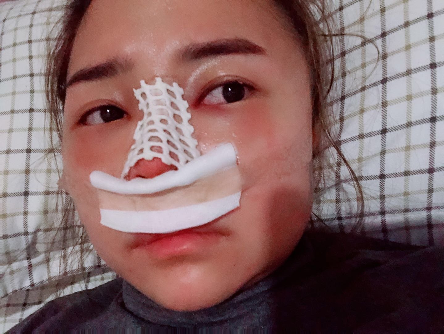 来成都奕后医疗美容做了自体肋软骨综合隆鼻手术.
