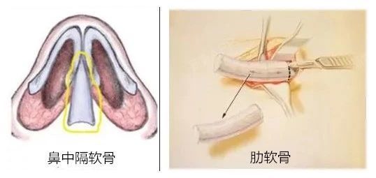 一般需要取用鼻中隔,肋软骨这类硬度较强的自体软骨重新行鼻小柱成型