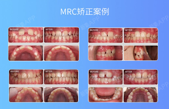 【隐形矫正】【特价】儿童mrc早期矫正器 干预矫正 预防牙齿畸形 保护