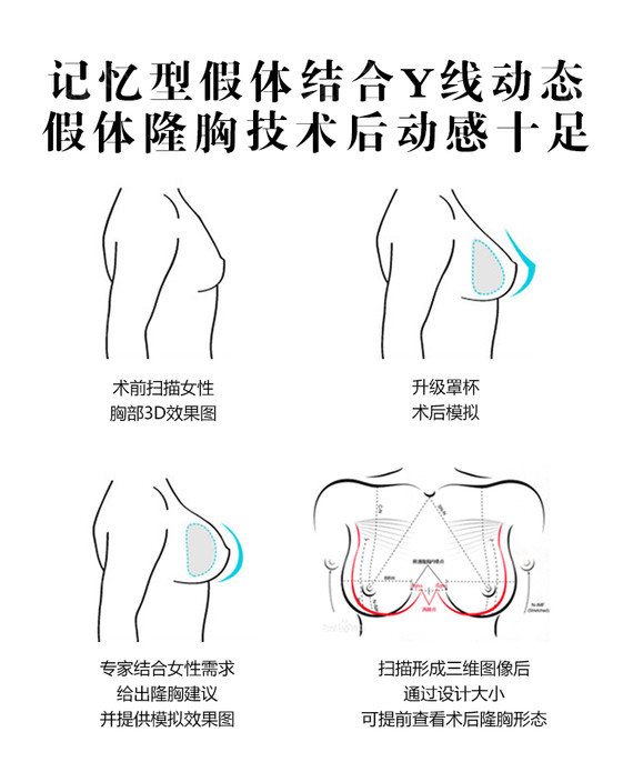 【假体隆胸】【专利技术】美国曼陀·圆盘假体隆胸,塑造胸部高挺魅力