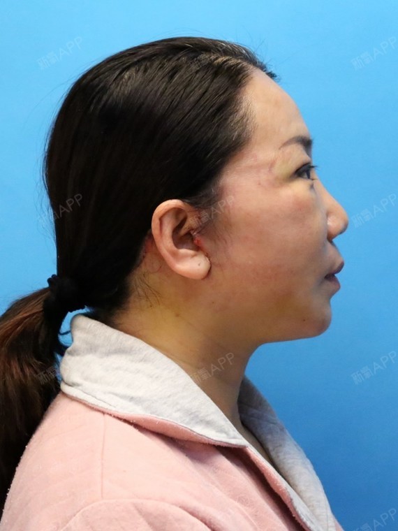 今天拆线了虽然有点疼但是都在能接受的范围内