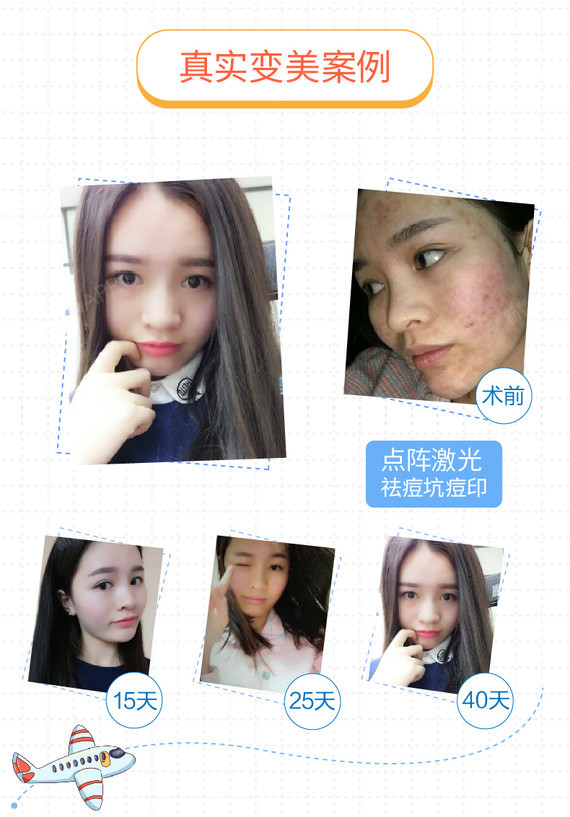 【点阵激光】飞梭全脸1次祛痘坑缩毛孔 欧洲之星点阵激光 麻膏 医用