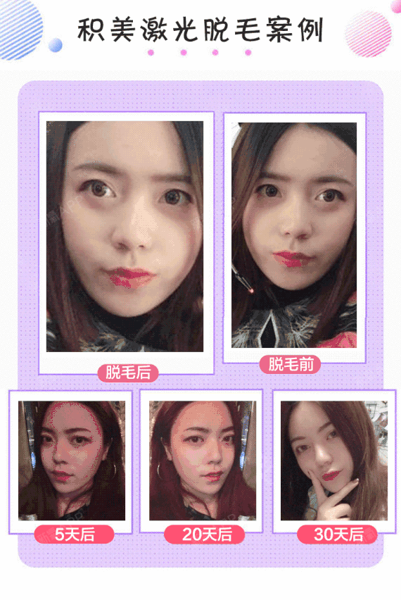 【激光脱毛】脱唇毛 一年12次 ,【脱毛我家强】激光脱毛 唇毛/腋毛 二