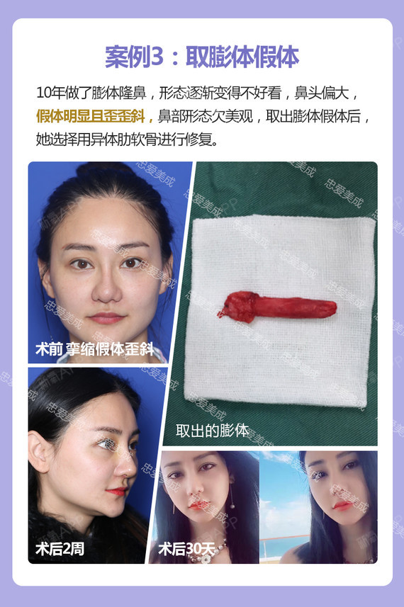 【鼻部硅胶假体取出】鼻部异物取出(假体/膨体/奥美定