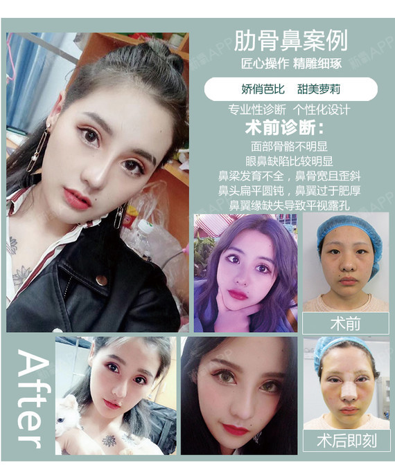 【肋软骨隆鼻【元素设计榫卯肋骨鼻综合】鼻综合/全肋鼻综合/肋软骨