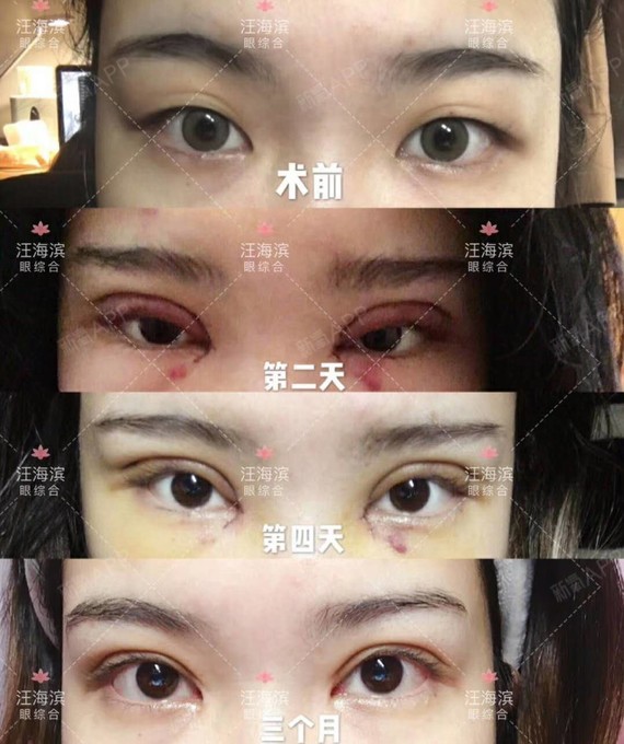 【干货】开眼角有疤痕增生怎么办?9898开眼角手术