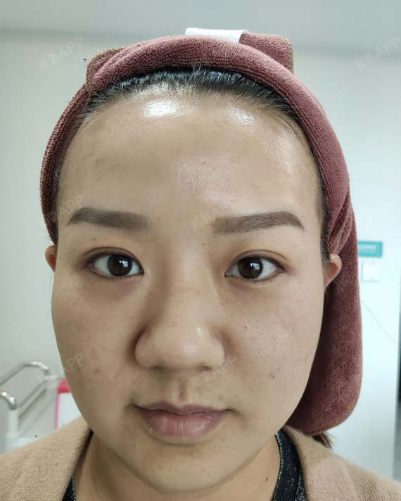 昆明射频溶脂瘦脸好不好_效果图_樱花海射频溶脂瘦脸0