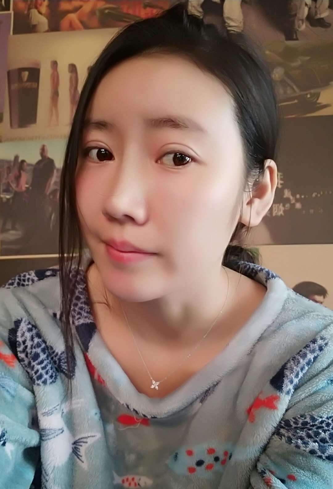 自体脂肪全脸填充第30天