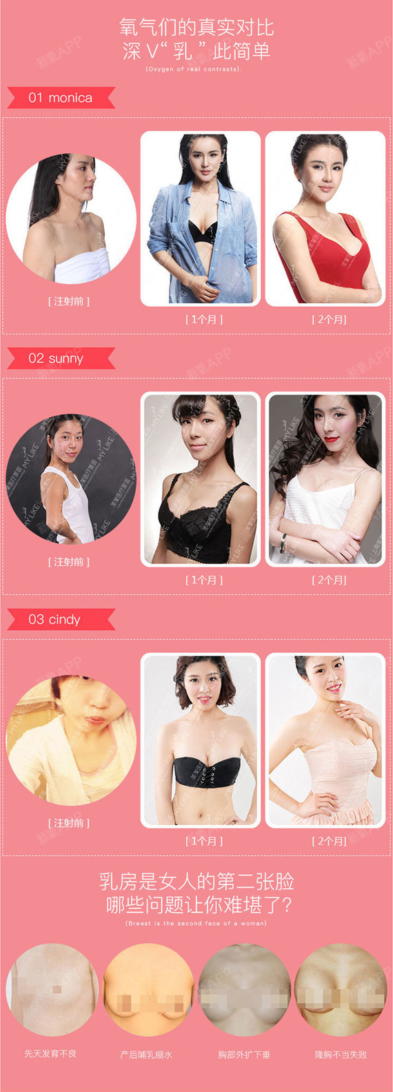 【假体隆胸】【曼托毛面假体丰胸】深"v"动感隆胸 精隙入型 恢复快不