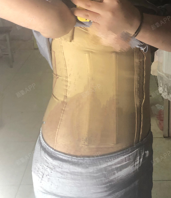 关于费用,我是在网上买的套餐,当时在打折,买的全身吸脂 面吸  然后