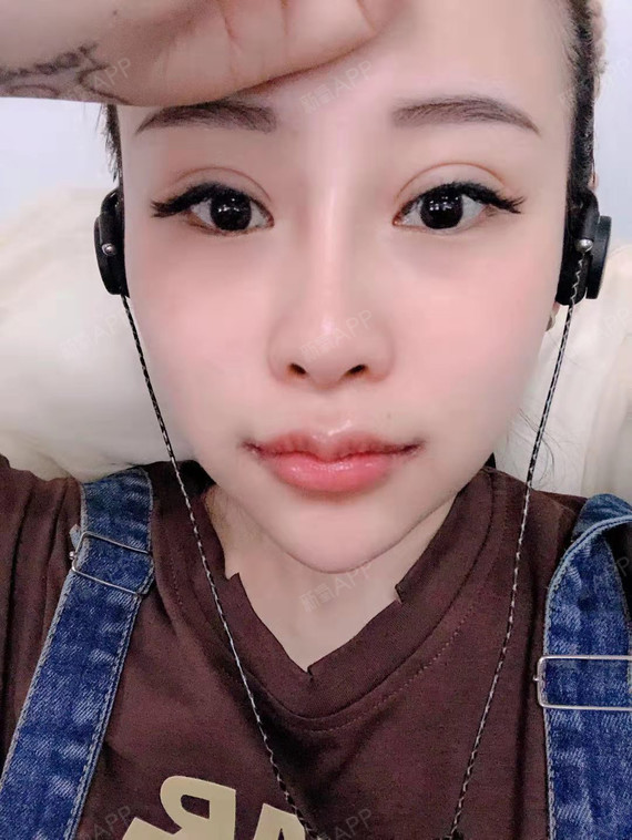 m唇手术