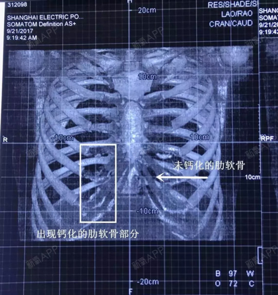 轻微钙化的肋软骨同样可以用来做综合隆鼻的支架,一般胸片图的肋软骨