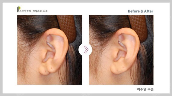 比如耳垂裂,耳垂畸形,耳垂缺损或者无耳垂,会采用软骨或者皮肤移植来