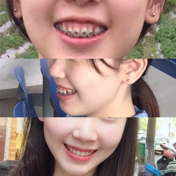 20岁正畸两年牙套经(轻微骨性&牙性龅牙 笑露牙龈