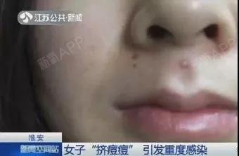 你的痘痘还好吗?