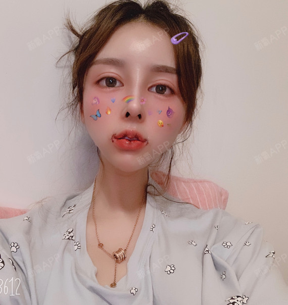 做花瓣唇,除了头几天用吸管喝流质,后面根本不影响吃_圈子-新氧美容