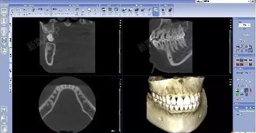 看牙为什么要拍x光片?有没有辐射伤害?