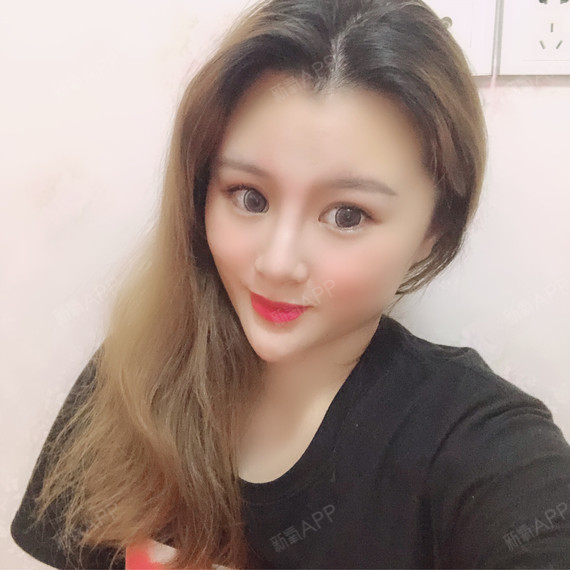 艾莹莹自体脂肪全脸填充第184天美丽日记