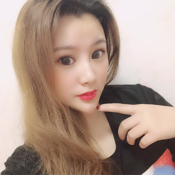 艾莹莹自体脂肪全脸填充第184天美丽日记