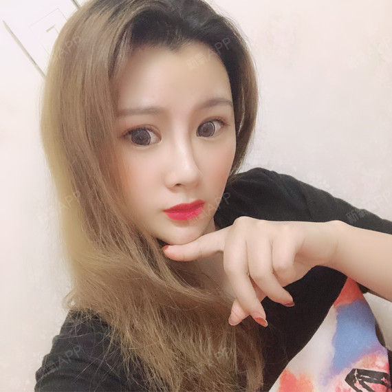 艾莹莹自体脂肪全脸填充第184天美丽日记
