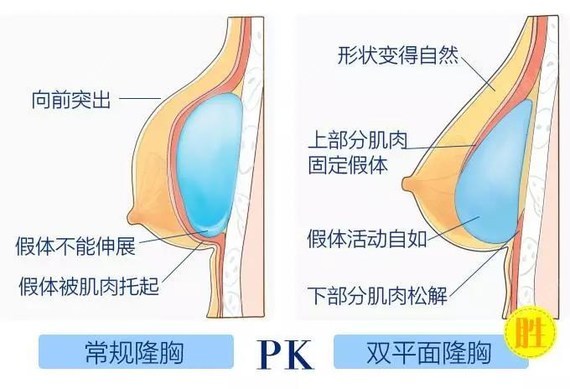 sem内窥镜双平面隆胸大咖