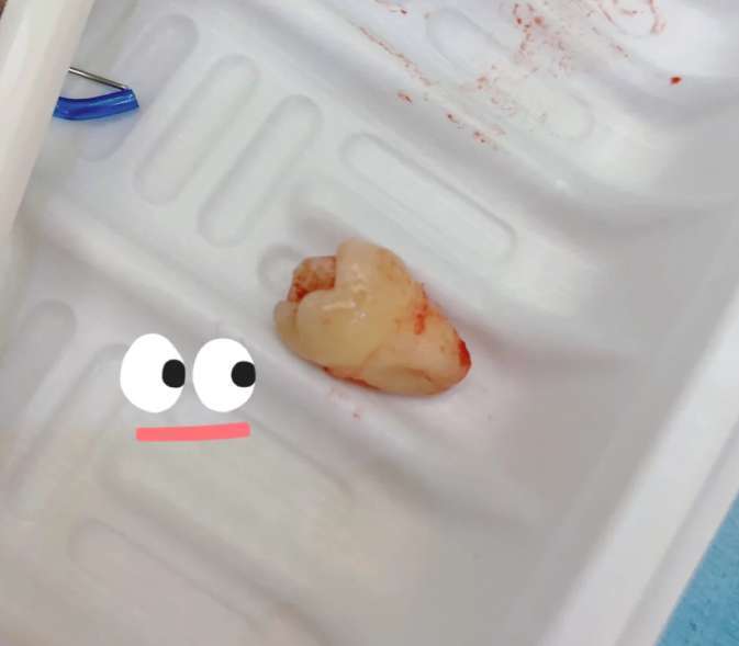 常州北极星口腔医院拔牙怎么样_恢复过程_效果如何__4