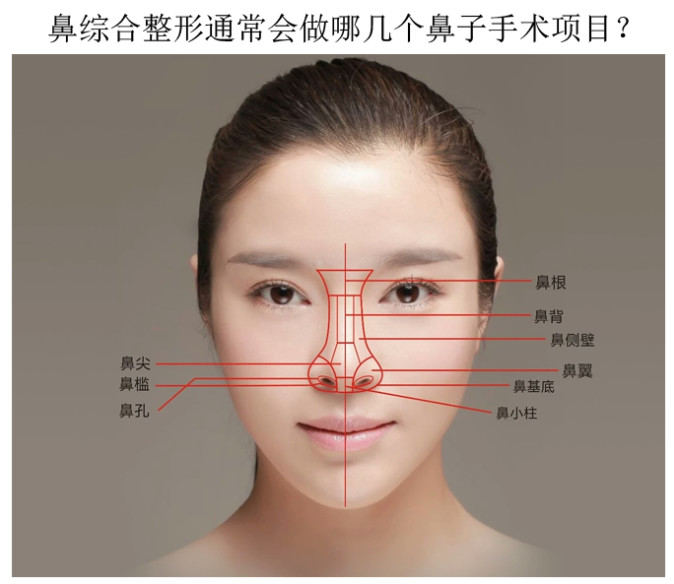 2,鼻背缩窄:主要针对鼻背部鼻骨宽大的患者,一般可在隆鼻的同时进行