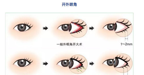 外眦开大手术是考虑眼睛左右距离短,延长外眼角的方法.