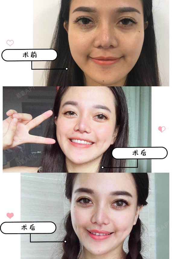酒窝成形术是面部整形手术