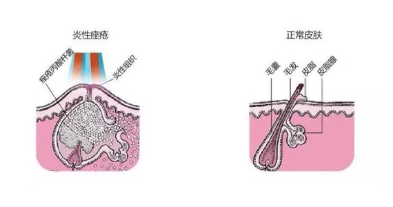 我们都知道,痤疮的形成主要与皮脂分泌过多,毛囊皮脂腺导管堵塞,细菌