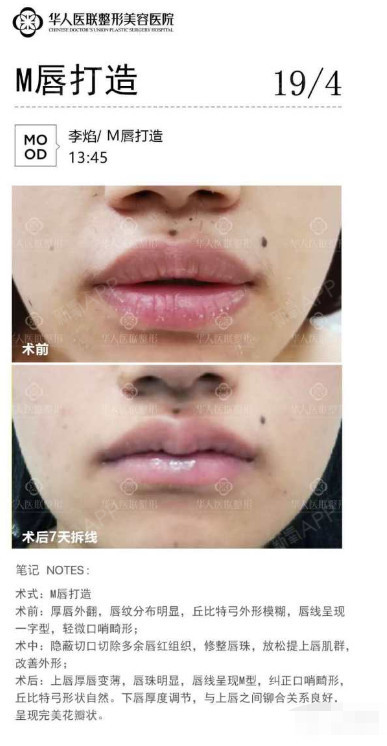 厚唇变薄术改进心得