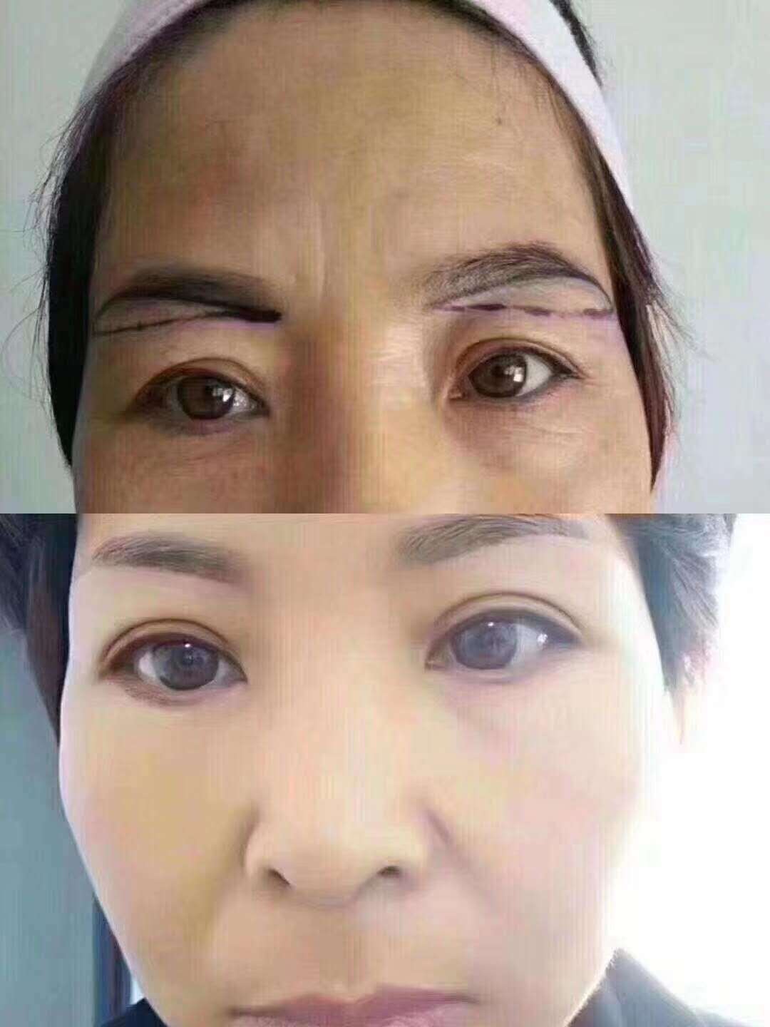 "切眉术"是目前医学面部整形中惟一的"一术六效"的美容项目,它可同时