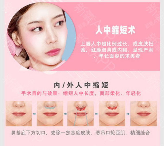 【人中缩短术】【人中加深】缩人中告别老态/鼻基底隐藏切口/院长亲台