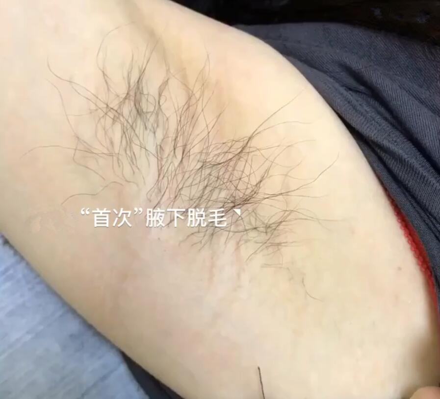 也考虑过做激光脱毛觉得会疼就不敢了,但是到了夏天腋毛又开始折磨我