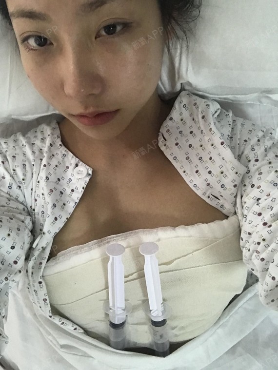 郝莱莱自体脂肪隆胸第0天美丽日记