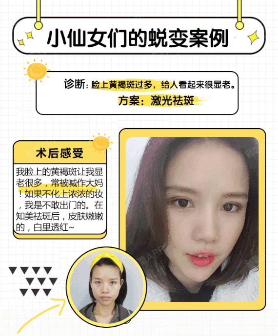 【激光祛斑】 【激光祛斑】【五月特惠】重塑瓷感裸肌