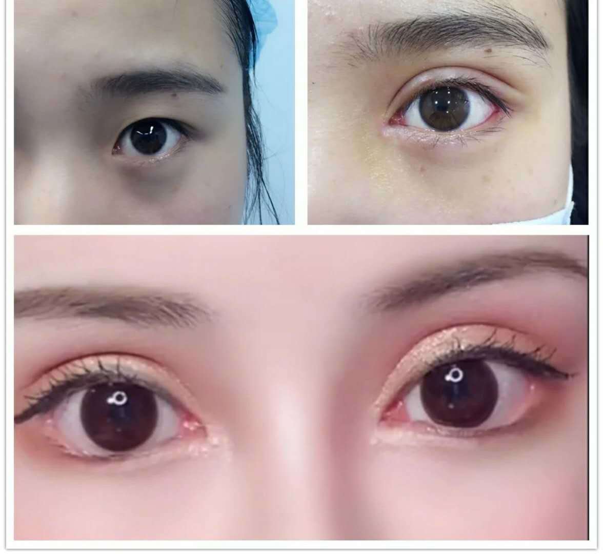 双眼皮 开内外眼角 去皮质 提肌 眼底脂肪重排)干货分享整形前后对比